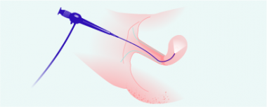 Gebärmutterspiegelung (Hysteroskopie) hero-image
