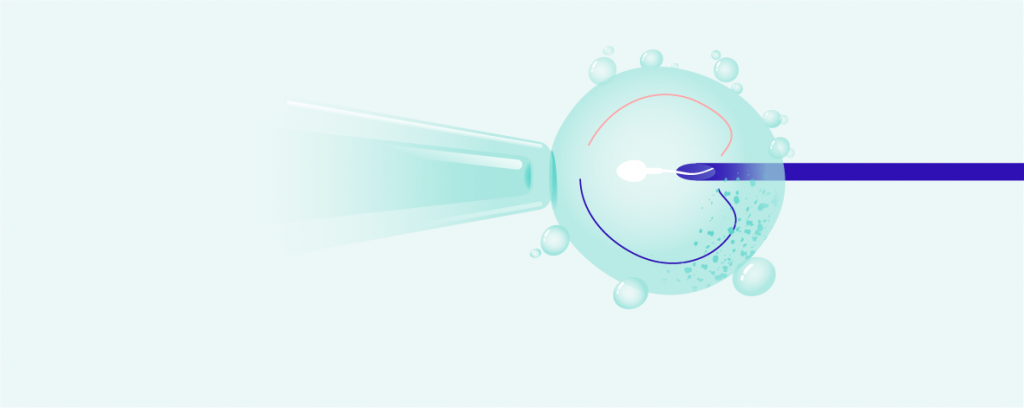 ICSI: injection of sperm directly into the egg hero-image