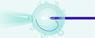 ICSI: spermatozoo direttamente nell'uovo hero-image