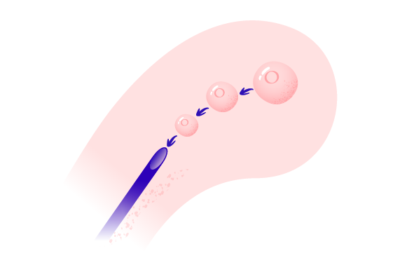 Retrieval of eggs and sperm image