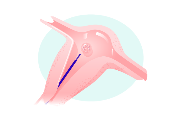 Transfer embrya image