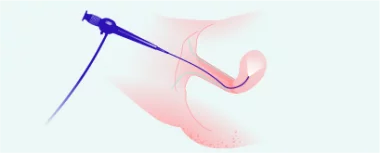 Hysteroskopie Praha hero-image